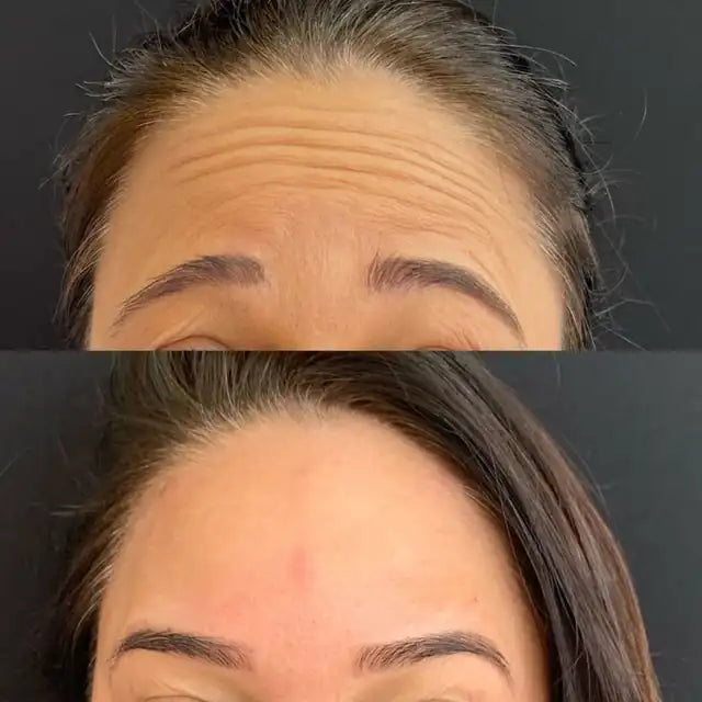 antes e depois da testa