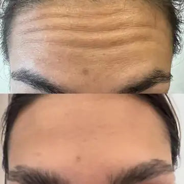 antes e depois da testa