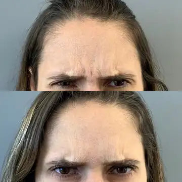 antes e depois da testa