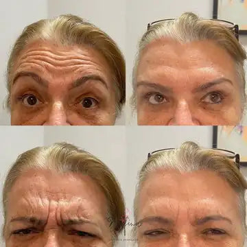 antes e depois da testa
