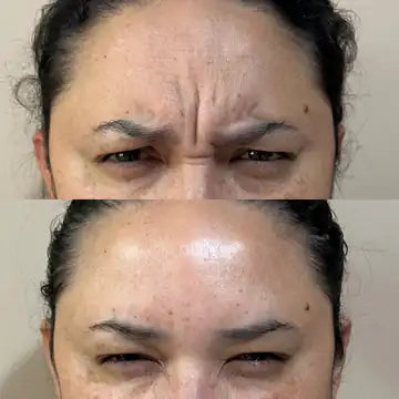 antes e depois da testa