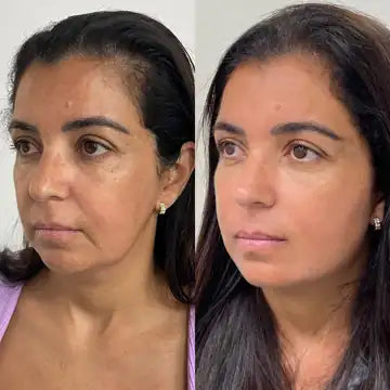 antes e depois da testa