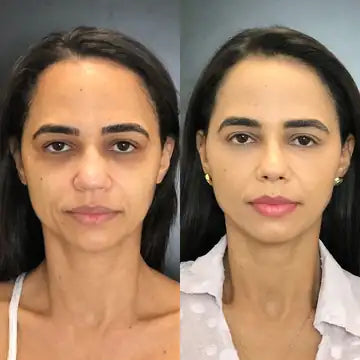 antes e depois da testa